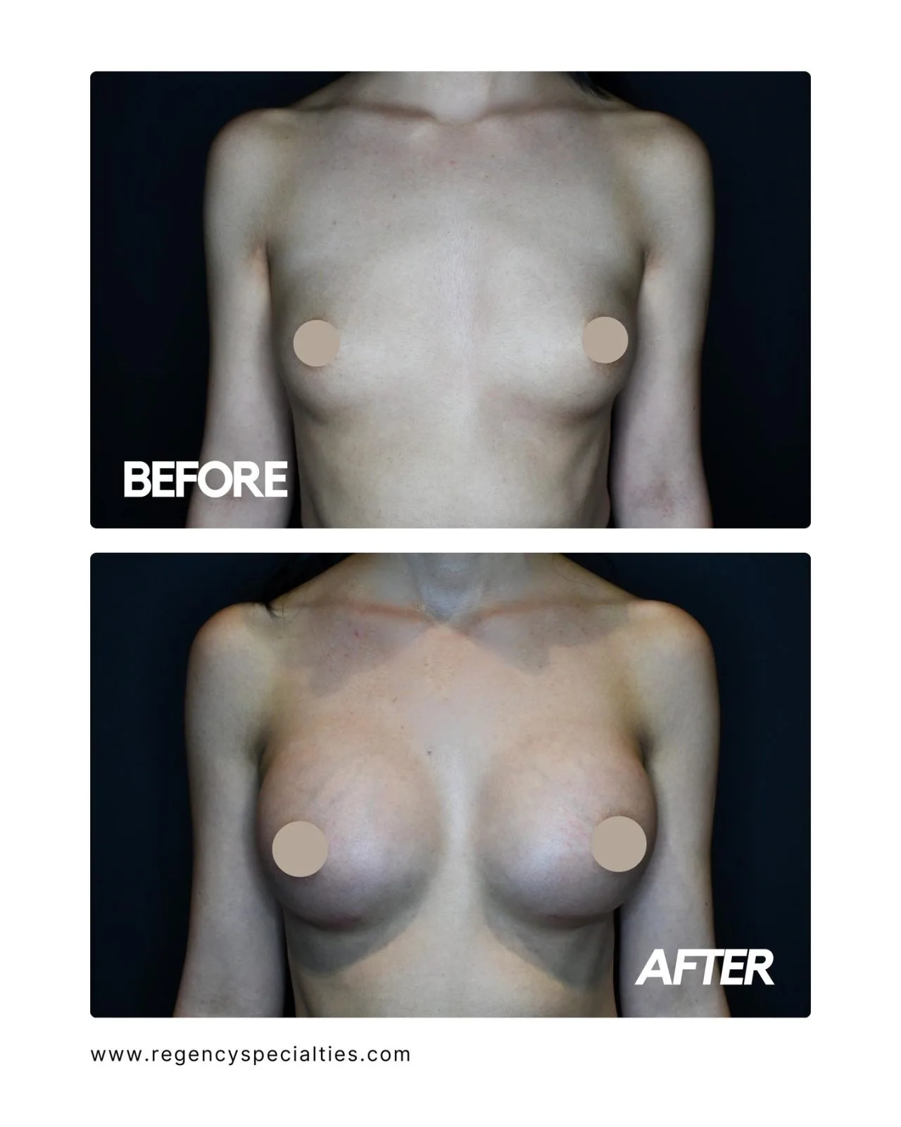 Before and after breast augmentation results showing increased volume and fullness